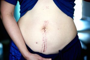 Lange gebärmutterentfernung bauchschnitt krank wie Gebärmutterentfernung (Hysterektomie)