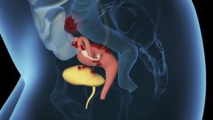 Endometriose im Unterbauch