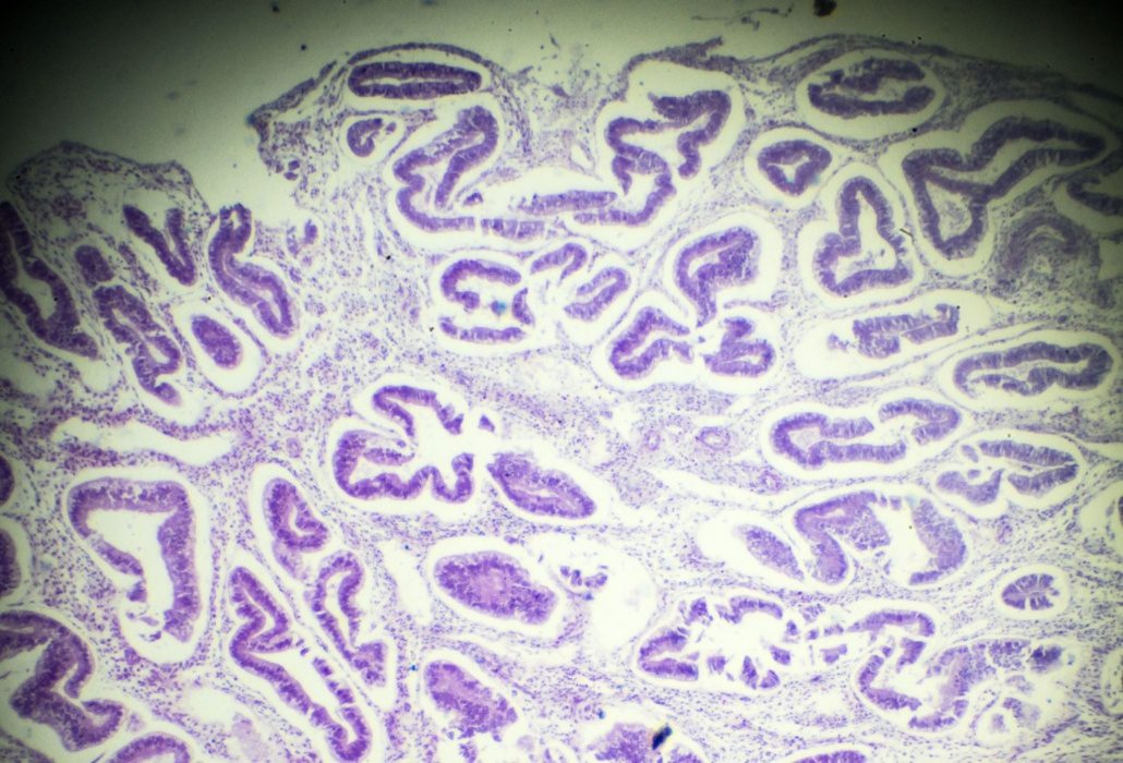 Adenomyose: Ursachen, Diagnostik und Therapie sowie Abgrenzung zur